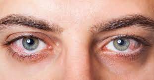 10 Best Ways To Prevent Pink Eye - Westchester Health Blog