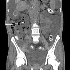 How often do i go to the cinema? Abdominal Ct Scans Shows Ascites Drainage Catheter Penetrating The Download Scientific Diagram