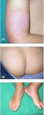 Image result for dermatitis contacta toxica