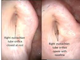 Image result for Eustachian Tube Dysfunction