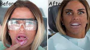 Katie price gave fans a glimpse of her teeth once her veneers had been removed, and they were haunted by what they saw. Katie Price Teeth With Without Veneers