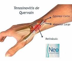 Tenosivovitis de Quervain