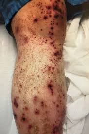 The most striking feature of this form of vasculitis is a purplish rash, typically on the lower legs and buttocks. Acute Kidney Injury In Patient With A Purpuric Rash Renal And Urology News