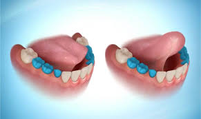 Image result for Ankyloglossia