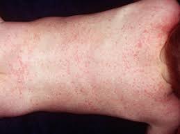 Disease Roseola Infantum | AI Care