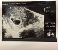 Although the gender of the baby is decided right at the fertilization stage, a mother won't know about 1. Our Little Precious One Baby 2 1st Prenatal Checkup 6 Weeks