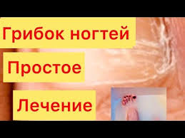 как вылечить грибок на ногах в домашних условиях видео Kak Vylechit Gribok Nogtej Za Kopejki Youtube Domashnee Lechenie Zhurnal O Zdorove Zdorove
