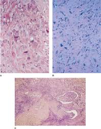 There is no curative treatment for mpm. Malignant Mesothelioma And Other Primary Pleural Tumors Thoracic Key