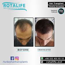 Before 5 Months After