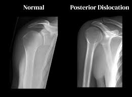 Image result for Shoulder XRay