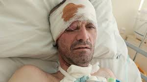 Bradys rehabilitation and recovery