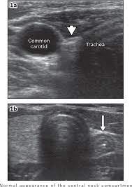 The scan is painless and only takes a few minutes. Figure 1 From Post Thyroidectomy Neck Ultrasonography In Patients With Thyroid Cancer And A Review Of The Literature Semantic Scholar