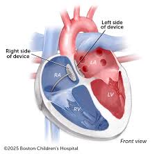 Image result for Atrial Septal Defect