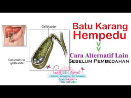 Sejak punca kanser pundi hempedu tidak diketahui, tiada kaedah pencegahan. Pemecah Batu Karang Punca Cara Merawat Masalah Batu Karang Kisah Ayah Yang Ada Batu Karang Youtube