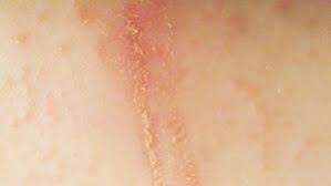 Image result for dry scabs on the head in children