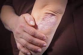 Ilustrasi kulit kering (thinkstockphotos.com) • 8 manfaat makan bayam bagi kesehatan yang wajib kamu ketahui, jaga kesehatan mata dan otot Kenali Gejala Dan Penyebab Psoriasis Yang Bisa Menyebar Ke Seluruh Tubuh