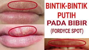 Biang keringat terjadi akibat keringat yang terjebak di bawah kulit dan menyumbat bintik merah karena biang keringat biasanya menyebar di sekitar leher, bahu, dada, ketiak, lipatan siku, dan lipatan paha. Bintik Bintik Putih Pada Bibir Bagian Atas Youtube