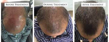 Welcomes men and women of all ages with a wide range of skin, aesthetic, cosmetic, tricology, and venereology in delhi, india. Mesotherapy For Hair Loss Cost In Delhi Midas Florence