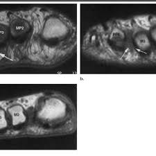Mortons neuroma is difficult to treat with conventional medicine. Pdf Morton Neuroma Mr Imaging In Prone Supine And Upright Weight Bearing Body Positions1