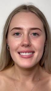 Before and after composite veneer treatment. After shots taken two weeks  post-treatment., Please note results shown are specific to this patient and  will vary for each individual. , All images and ...