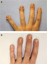 Apr 02, 2020 · landis mn, et al. Recalcitrant Viral Warts Treated With Photodynamic Therapy Methyl Aminolevulinate And Red Light 630 Nm A Case Series Of 51 Patients Springerlink