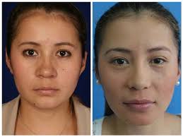 Bichectomía madrid antes y después. Bichectomia Adelgazamiento Facial Doctor Julio Cesar Acosta Cirujano Plastico