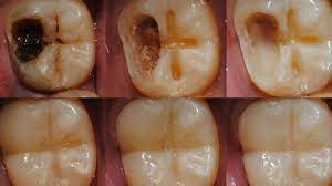 Baby teeth will usually fall out on their own, so it's not necessary to extract them. Scientists Develop Gel That Can Regrow Tooth Enamel