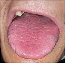 Image result for Fissured tongue