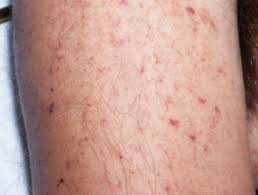 Purpura, petechiae, or ulcers may develop. Meningococcal Disease Dermnet Nz