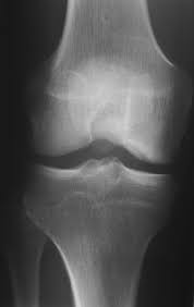 Check spelling or type a new query. Ocd At The Lateral Aspect Of The Medial Femoral Condyle Download Scientific Diagram