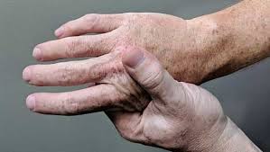 Bone marrow cancer happens when cells in the marrow begin to grow abnormally. Multiple Myeloma Treatment Certain Sugars Can Arrest Bone Perforation And Cancer Progression Indicates Study Conducted On Mice Health News Firstpost