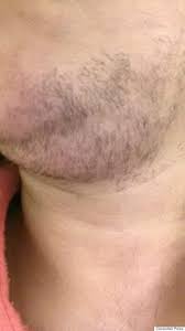 In this article, we discuss how exactly laser hair removal can help with hirsutism, and why it might be a better option compared to medical treatments. Woman With Pcos Who Shaves Three Times Per Day Refused Laser Hair Removal Treatment On Nhs Because It S Too Cosmetic Huffpost Uk Life