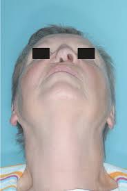 Clinical presentation the presentation can vary, ranging from exophthalmos, rhinorrhea, and ophthalmoplegia. Figure 1 From Mucormycosis Of The Head And Neck Semantic Scholar
