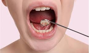 Image result for dental cancer