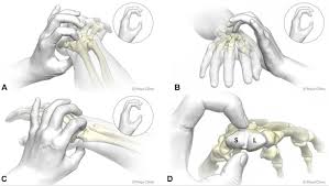 Image result for Scaphoid Shift Test
