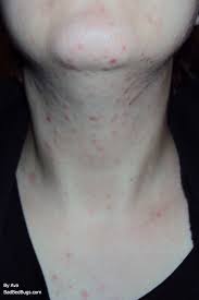 Mite Bites