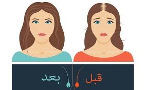 مين جربت حقن البلازما للشعر 2021 تجربتي مع حقن البلازما للشعر تجميلي