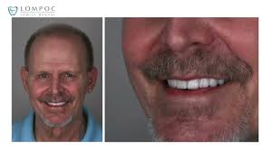 Lompoc Dental Implants