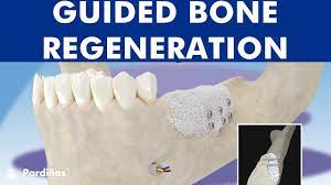 Guided Bone Regeneration Bone Graft C Youtube