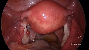 Jun 11, 2021 · insurance coverage. Laparoscopic Reversal Tubal Sterilisation Auckland Gynaecologist Advanced Laparoscopic Surgeon Dr Michael Wynn Williams