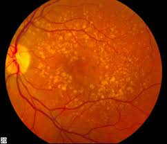 Laser eye surgery is recommended for people aged 18 or older. Macular Degeneration Wikipedia
