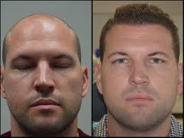 Just a short distance from century city and beverly hills, our new clinic is aron came to our clinic in los angeles for a full mht® treatment to remedy his hair loss. Fue Hair Transplant Los Angeles Los Angeles Fue Hair Replacement Los Angeles Fue Hair Transplant Clinic