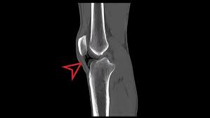 Image result for Traumatic Arthrotomy