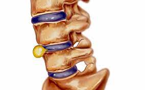 Cel mai bun neurochirurg hernie de disc. Medic Specialist In Neurochirurgie Hernia De Disc NeoperatÄƒ La Timp Sau NetratatÄƒ Poate Duce La Paralizie