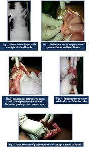 Adnexitis is a very acute inflammation of the uterine appendages (ovaries and fallopian tubes). Retroperitoneal Necrotizing Fasciitis With Adnexitis Presenting As Acute Abdomen In A 40 Year Unmarried Female Patient A Case Report Semantic Scholar