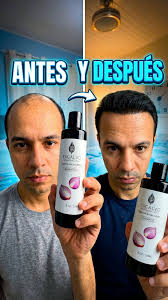 Antes y después de usar el shampoo ExCalvo