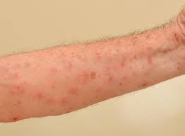 Kratze Scabies Ursache Beschwerden Behandlung