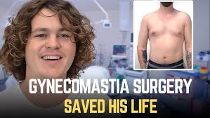 Say Goodbye to Gynecomastia: Causes, Treatment Options, and Real Results!