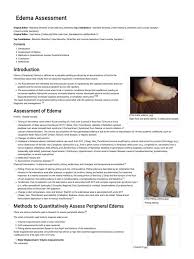 Image result for Edema Exam