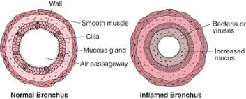 bronchitis symptoms treatments causes lung and airway